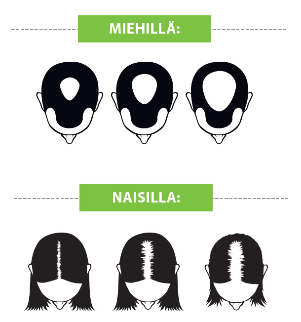 Perinnöllinen hiustenlähtö_v2.jpg