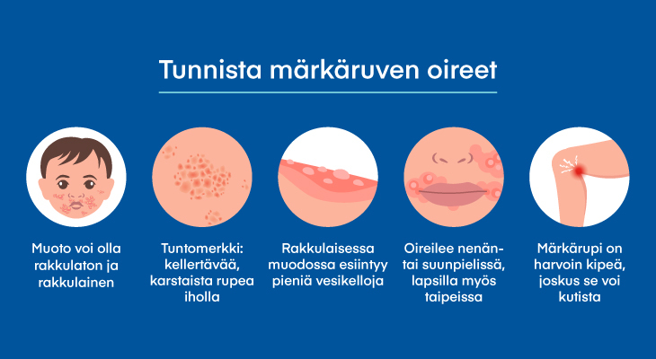 M rk rupi Oireet Ja Hoito Itsehoitoapteekki