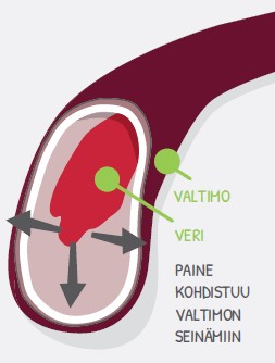 Mitä verenpaine on.jpg